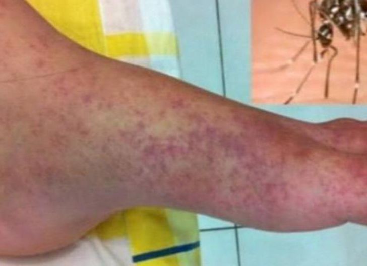 Photo of Pegawai Pemkab Landak Kena Chikungunya hingga 3 Minggu Tidak Kerja